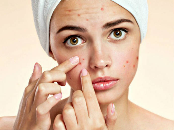 Dùng tinh dầu xả xông hơi trị mụn như thế nào hiệu quả