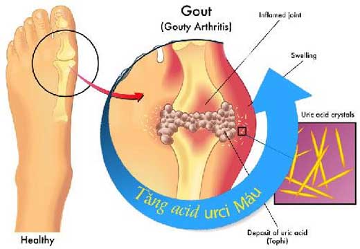 Chậu ngâm matxa chân dành cho người bị bệnh gout 