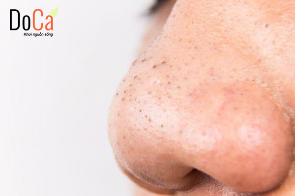 Xông hơi trị mụn đầu đen